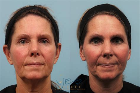 Face Lift & Neck Lift Before & After Photos Patient 201 | Vancouver, BC ...