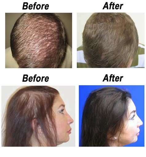 Regrow Your Hair Before It All Falls Out - Buffalo Laser Spa