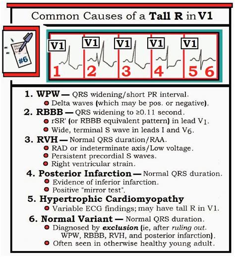 ECG Interpretation: ECG Interpretation Review #81 (Tall R Wave in Lead ...