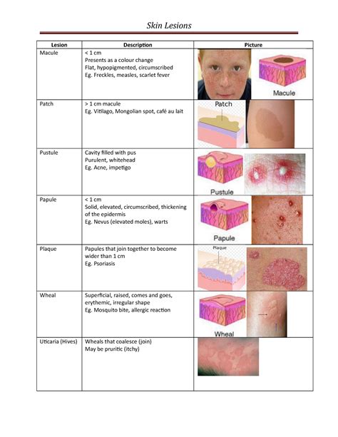 Macule Vs Papule