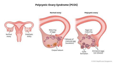 Polycystic Ovary Syndrome (PCOS) - Causes and Symptoms | Parkway East ...