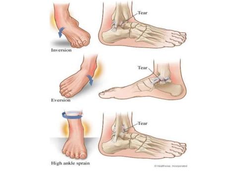 Ankle Sprain Grades