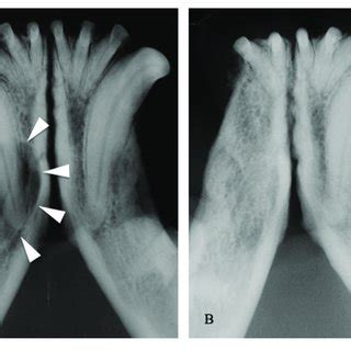 | (A) Intraoral radiograph showing a dentigerous cyst (arrowheads ...