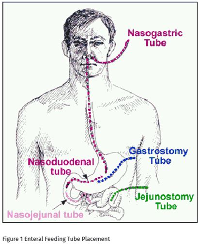 Nj feeding tube