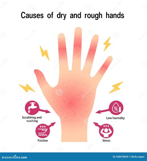 Causes of Dry and Rough Hands Chapped Hands Vector Illustration Stock ...