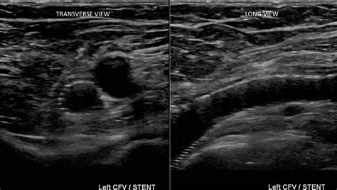 Iliac vein stent Ultrasound - Angiologist