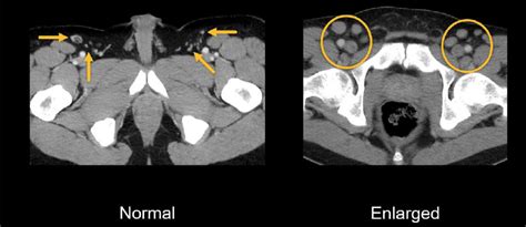 Abdominal CT: lymph nodes • LITFL • Radiology Library