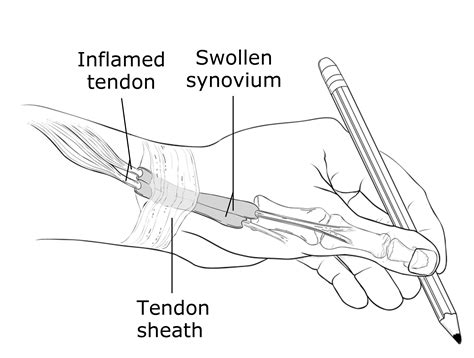 Thumb Tendonitis (Dequervains) – Dr. Brook Adams, MD