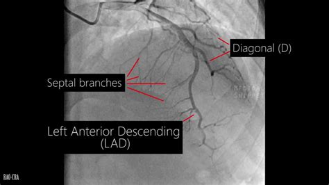 Coronary Angio Anatomy