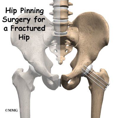 Hip Pinning Surgery for a Fractured Hip - Orthopedic Surgery, Algonquin ...