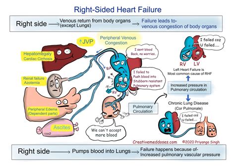 Heart Failure: Left sided VS Right sided - Creative Med Doses