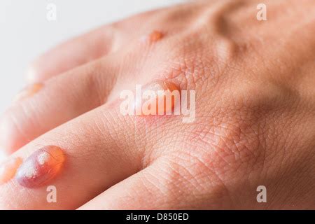 Man's hand covered with blisters caused by cryosurgery - wart removal ...