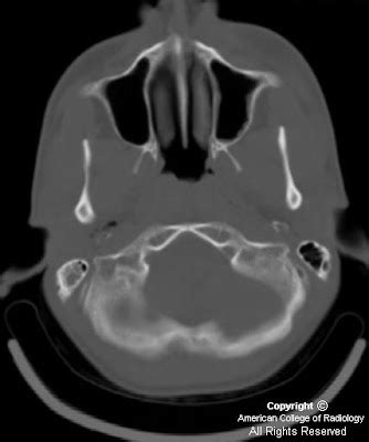 Neuroradiology On the Net: Temporal bone fracture