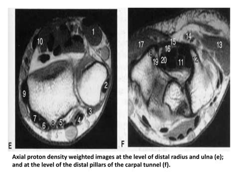 Muscular anatomy of upper limb, MRI Anatomy | PPT