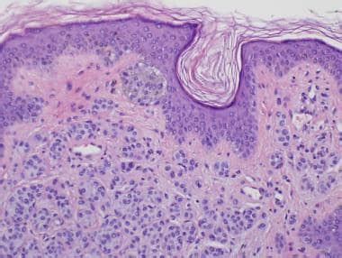 Pathology of Benign Melanocytic Nevi: Overview, Pathophysiology and ...