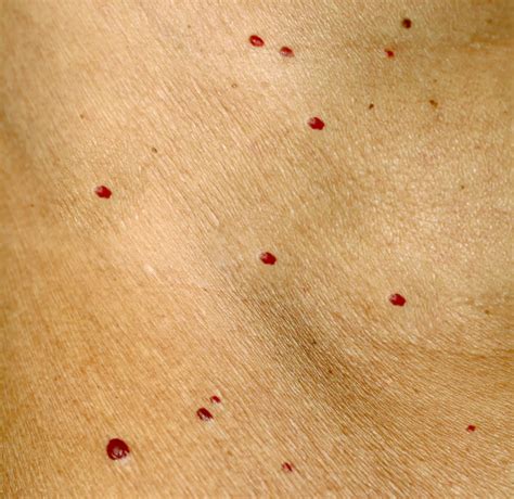 Red Dots on Skin: 19 Causes, Some Serious » Scary Symptoms