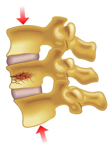 Spinal Fracture - Sarasota Spine Specialists