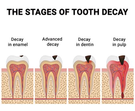 Tooth Cavity Treatment