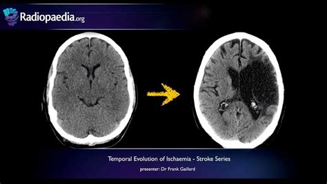 Stroke: Acute infarction - radiology video tutorial (CT, MRI ...