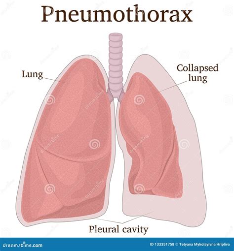 Pneumothorax Cartoon Vector | CartoonDealer.com #47808847