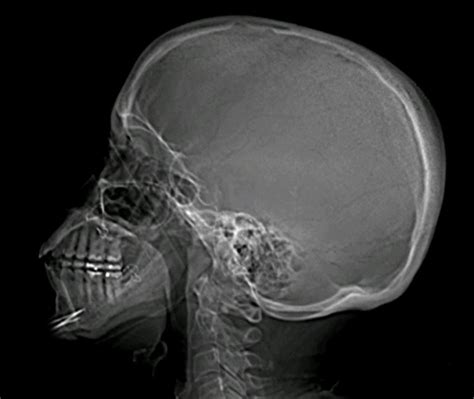 SKULL XRAYS LATERAL VIEW | Buyxraysonline