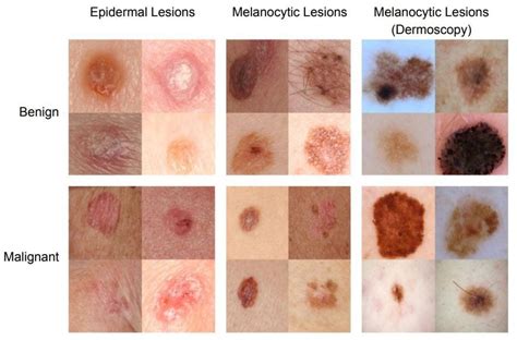 Fico! 28+ Fatti su Melanoma Stages Of Skin Cancer! Accreditation ...