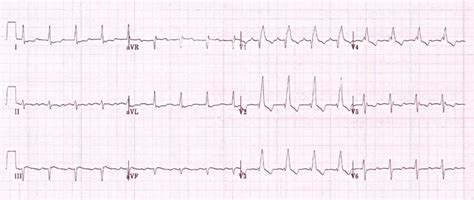 Heart Palpitations Symptoms | Heart Health | OneWelbeck