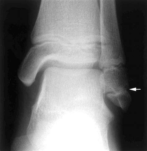 Accessory ossicle or intraepiphyseal fracture of lateral malleolus: are ...