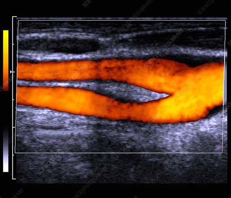 Carotid artery, doppler ultrasound - Stock Image - P206/0282 - Science ...