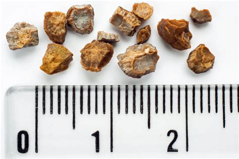 Cystine Kidney Stones