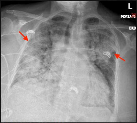 Pulmonary Hemorrhage X Ray