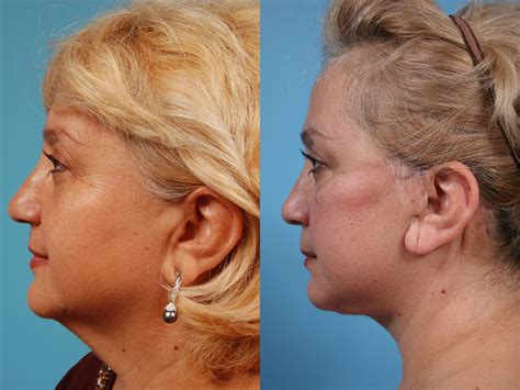 Neck Lift Before & After Photos Patient 142 | Chicago, IL | TLKM ...