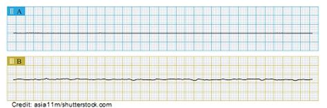 Ventricular Fibrillation (V-fib) ECG/EKG Nursing Review