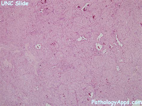 oncocytoma pathology