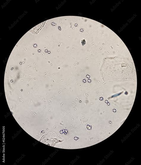 Microscopic image showing Calcium oxalate (monohydrate and dihydrate ...