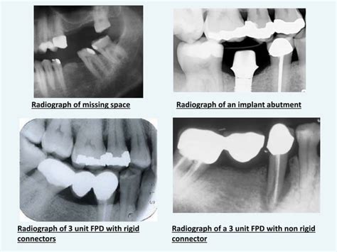 Design of a fixed Partial Denture (with Abutment Tooth Preparation) | PPT