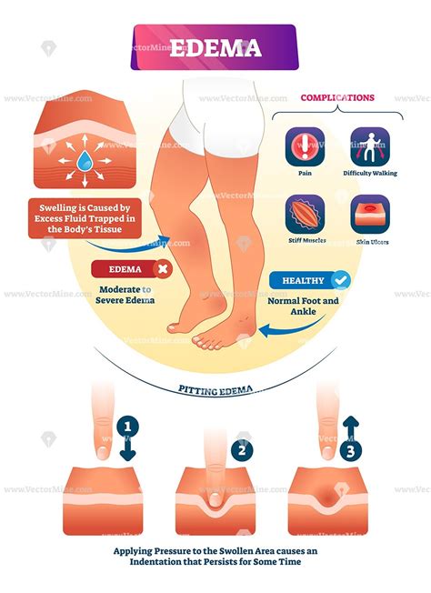 Edema skin condition vector illustration infographic diagram | Edema ...