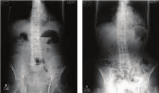 Abdominal X-ray radiographs of a 95-year-old paralytic ileus patient ...