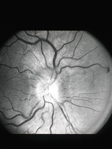 Optic Disk Edema - Retina Image Bank