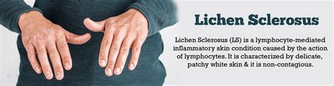 Lichen Sclerosus - Causes Symptoms Diagnosis Treatment