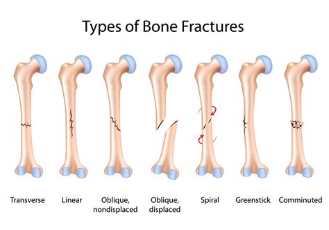 Shoulder Fractures - Physical Therapy, Sterling, VA