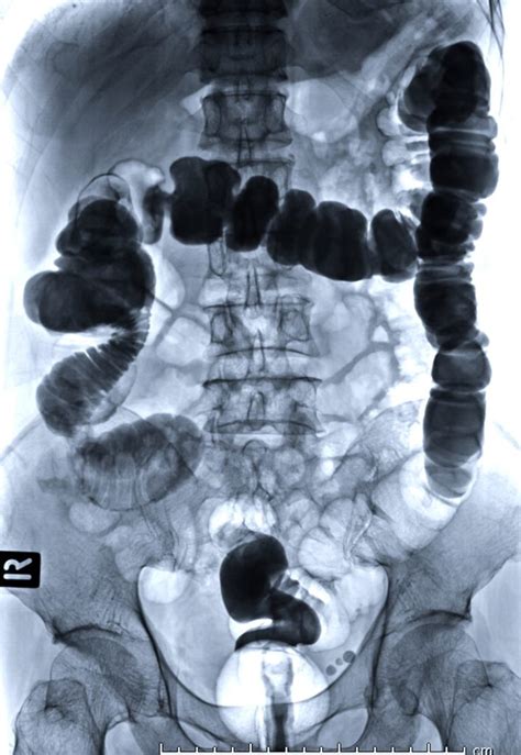 Computed Tomography of the Abdomen/Pelvis| Radiology Associates of ...