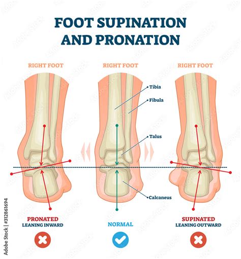 Vettoriale Stock Foot supination and pronation vector illustration ...