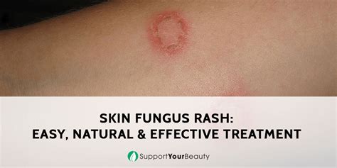 Fungal Rash On Skin