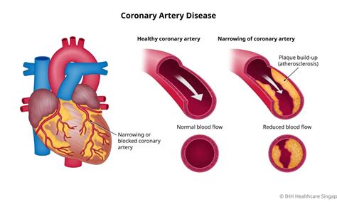 What is coronary artery disease? - FITPAA