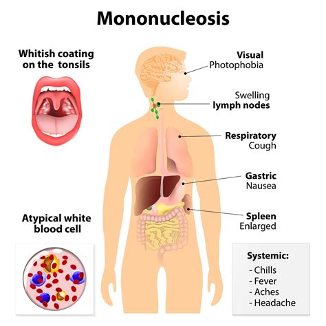 Infectious Mononucleosis Symptoms - Goimages 411