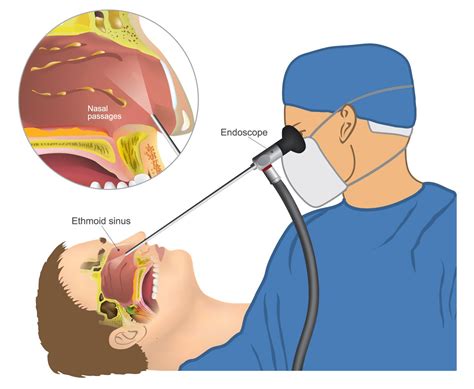 Endoscopic Sinus Surgery - Long Island, NY - Dr. Michael S. Cohen