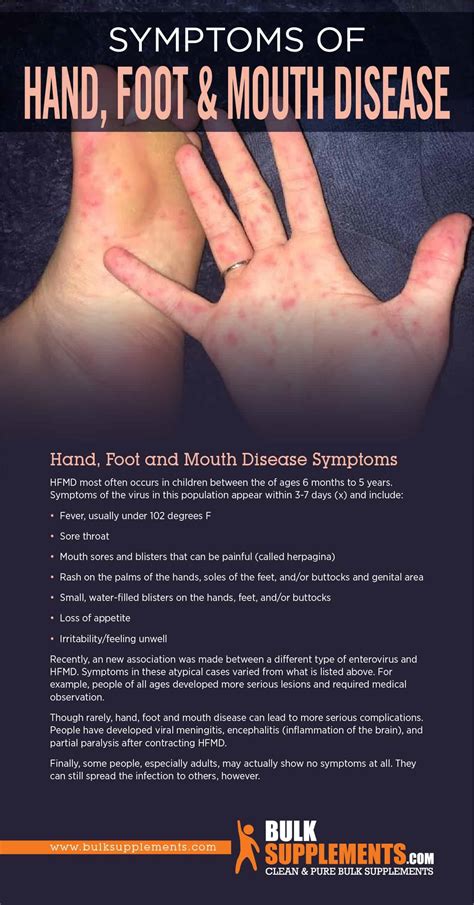 Hand Foot Mouth Disease Symptoms - Discover 10 common hand foot and ...