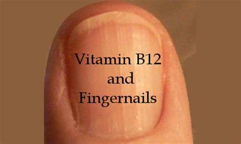 White Lines On Nails Vitamin Deficiency - 17 You can discover top ...