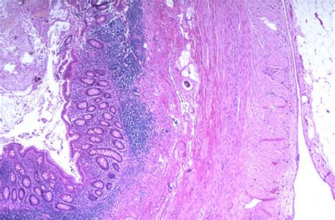 Appendicitis Histology